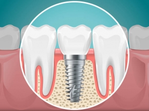 The Ultimate Guide to Teeth Whitening: Options and Benefits in Abu Dhabi