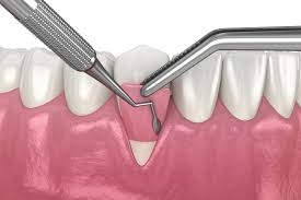 Receding Gums: Causes and Risk Factors