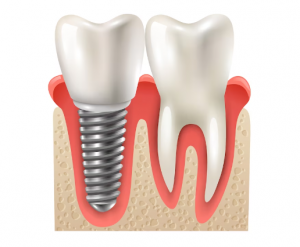 3 REASONS WHY DENTAL IMPLANTS ARE IMPORTANT