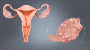 Polycystic Ovary Syndrome (PCOS) - Symptoms, Implications, Timely Detection, and Treatment Management
