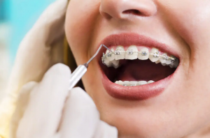 Birmingham Braces Cost and Insurance: What to Know