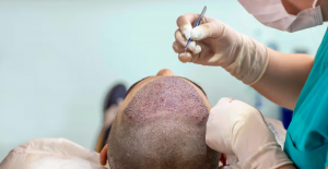 Hair Transplant in Turkey: Costs & Tips