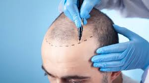 Hair Transplant cost in Dubai