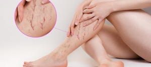 Leg Revival: Cutting-Edge Spider Veins Solutions