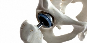 Choosing the Best Hip Replacement Surgeons in Chandigarh