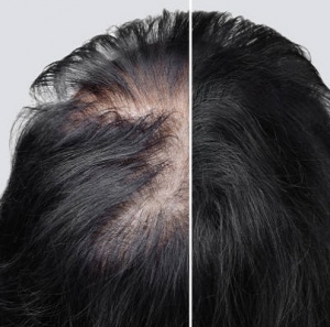 Hair loss & Hair Fall Treatment Dubai and UAE ?