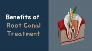 What are the Benefits of Root Canal Treatment?