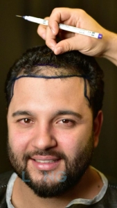 Elevate Your Look: Discover Exceptional Hair Transplant in Islamabad