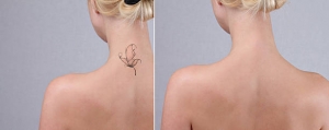 Resetting the Canvas: Laser Tattoo Removal Innovations in Riyadh