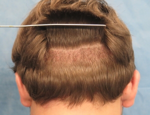 A Comparison Between Strip Harvesting and FUE Hair Transplants ?