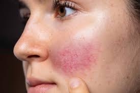 The Pinnacle of Skincare: Best Rosacea Treatments in Dubai