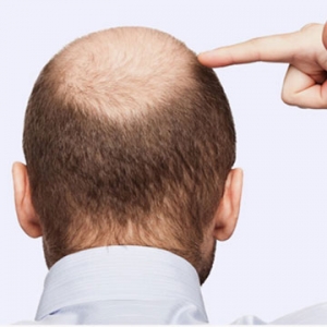 Benefits of Hair Transplant Surgery Dubai ?