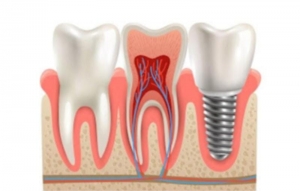 Top Factors to Consider When Getting Dental Implants