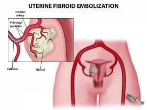 Understanding Uterine Fibroid Embolization (UFE) Side Effects