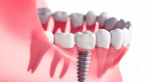 Comprender Los Beneficios De Los Implantes Dentales Para Restaurar Su Sonrisa