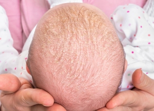 Natural Remedies for Cradle Cap in Infants