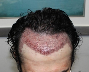 What are the Differences Between FUE and FUT hair transplants?