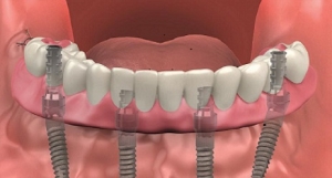 Elegir Al Especialista En Implantes Dentales Adecuado Para Sus Necesidades