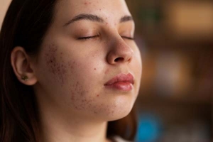 5 Things You Must Consider Before Ordering Tretinoin Online
