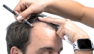 Restoring Confidence: An In-Depth Exploration of Hair Transplant Procedures