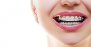 Partial Braces and Front Tooth Alignment: What to Know