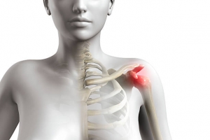 Impingement Syndrome is Estimated to Witness High Growth Owing to Rise in Sports-related Injuries