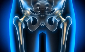 Hip Replacement Market is projected to Witness High Growth Owing to Growing Geriatric Population