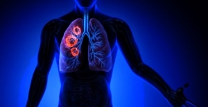 Atezolizumab Market is Estimated to Witness High Growth Owing to Increasing Immuno-oncology Clinical Trials