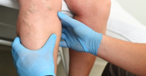 What is the Difference Between Sclerotherapy and Phlebectomy