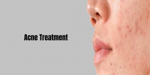 Deep Acne Scar Treatment With Peels 