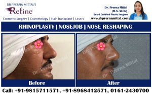 Rhinoplasty Surgery Explore the Benefits