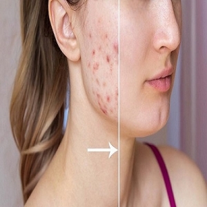 How to Choose the Best Dermatologist for Your Acne Scars in Islamabad