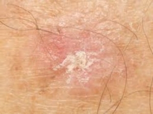 The Actinic Keratosis Market Poised for Growth Owing to Rising Geriatric Population 