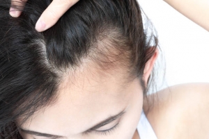 10 Ways of Treating Female Hair Loss ?