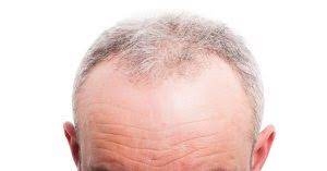 Can a hair transplant be done for individuals with a history of bleeding disorders?