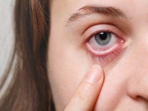 Eye Flu (Conjunctivitis) Market Estimated to Witness High Growth Owing to Increasing Prevalence of Allergic Conjunctivitis