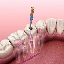 Navigating the Precision of Root Canal Therapy in Islamabad: An In-Depth Exploration