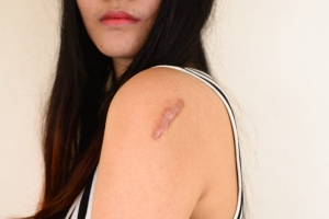 Integrative Keloid Treatment Approaches in Dubai