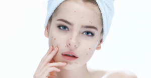 Experience Clearer Skin: Acne Treatment in Dubai