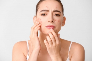 Expert Insights on Acne Treatment in Dubai