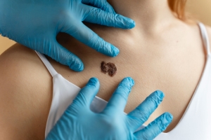 Dermoscopy Mastery: Mole Evaluation in Dubai - Unveiling the Art of Skin Analysis
