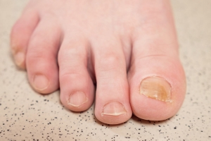 Nail Disorder Treatment Options Tailored to You in Dubai