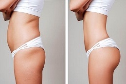 Fat Meltdown: Cutting-Edge Lipolysis Treatment