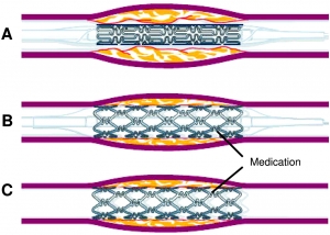 Drug Eluting Stent Market Size, Share Analysis, Key Companies, and Forecast To 2030