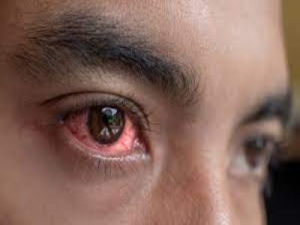 Eye Flu (Conjunctivitis) Market is Estimated to Witness High Growth Owing to Increasing Prevalence of Allergies