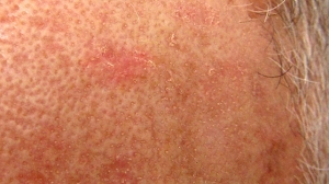 Comprehensive Guide to Actinic Keratosis Treatment in Dubai: Understanding and Management