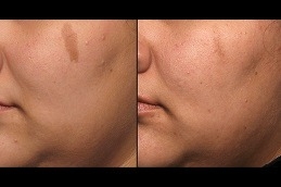 Pico Laser: The Ultimate Solution for Acne Scarring