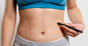 Transform your abdomen with a tummy tuck in Dubai – remove excess skin and fat, tighten muscles, and boost your confidence!