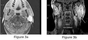 Know About the Parotid Cancer and Its Symptoms before Treatment 