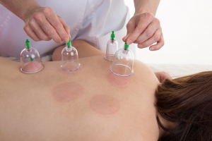 Discover the Ancient Healing Art of Hijama in Dubai